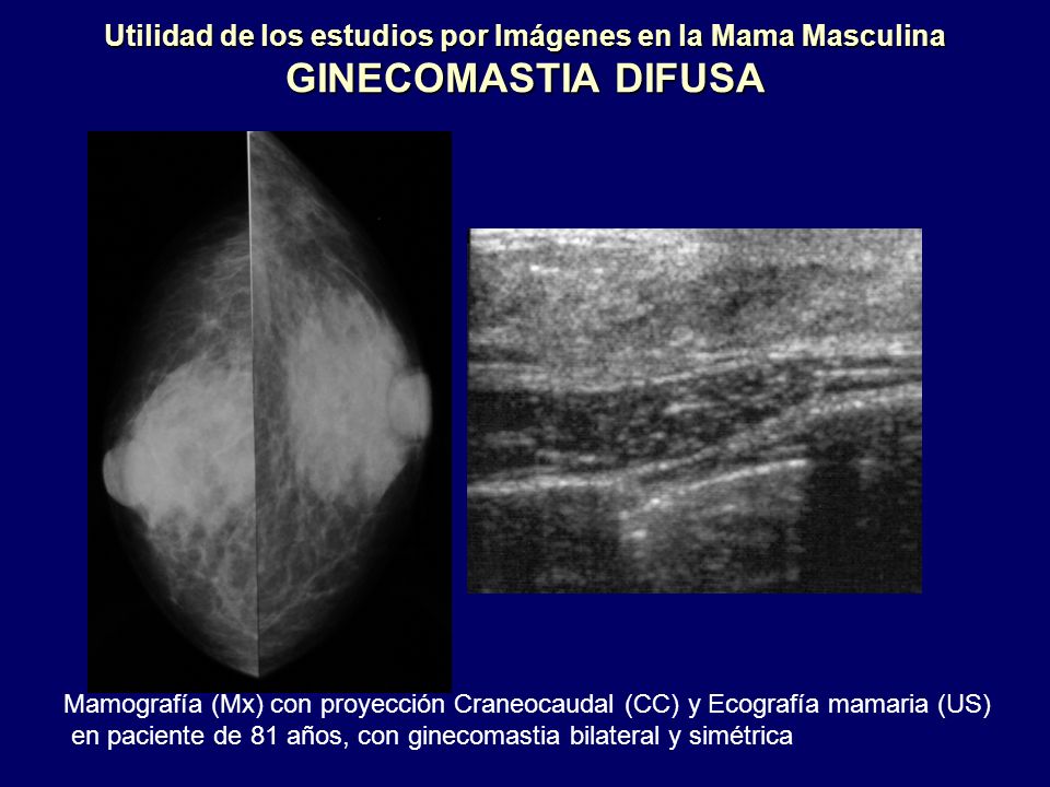 Utilidad de los estudios por Imágenes en la Mama Masculina GINECOMASTIA DIFUSA