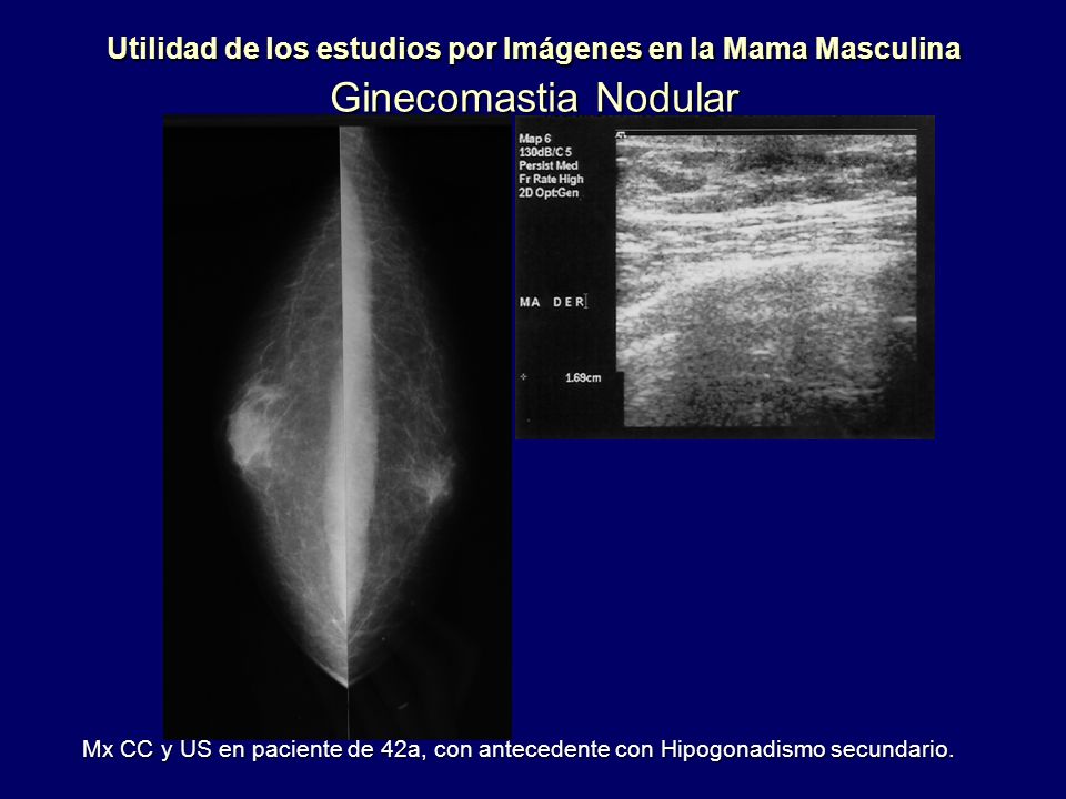 Utilidad de los estudios por Imágenes en la Mama Masculina Ginecomastia Nodular