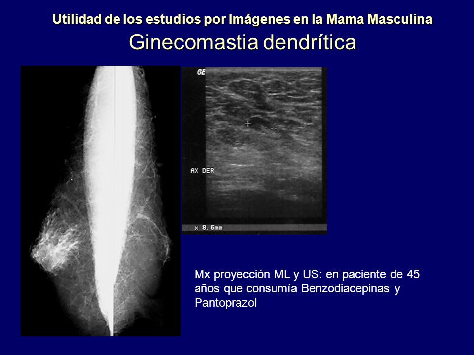Utilidad de los estudios por Imágenes en la Mama Masculina Ginecomastia dendrítica