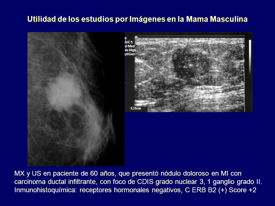 Utilidad de los estudios por Imágenes en la Mama Masculina