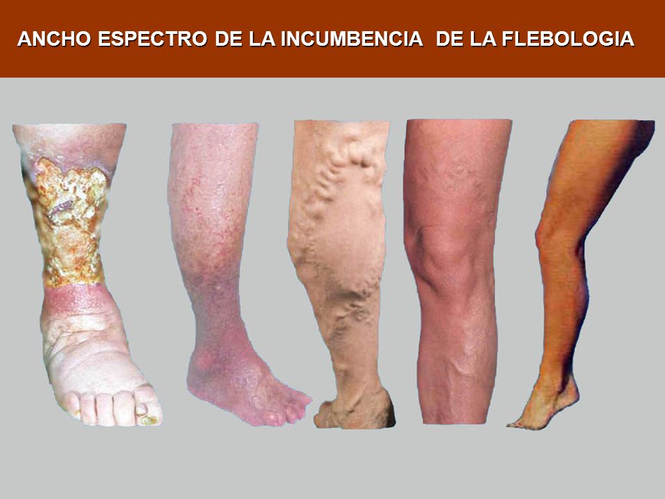 ANCHO ESPECTRO DE LA INCUMBENCIA DE LA FLEBOLOGIA