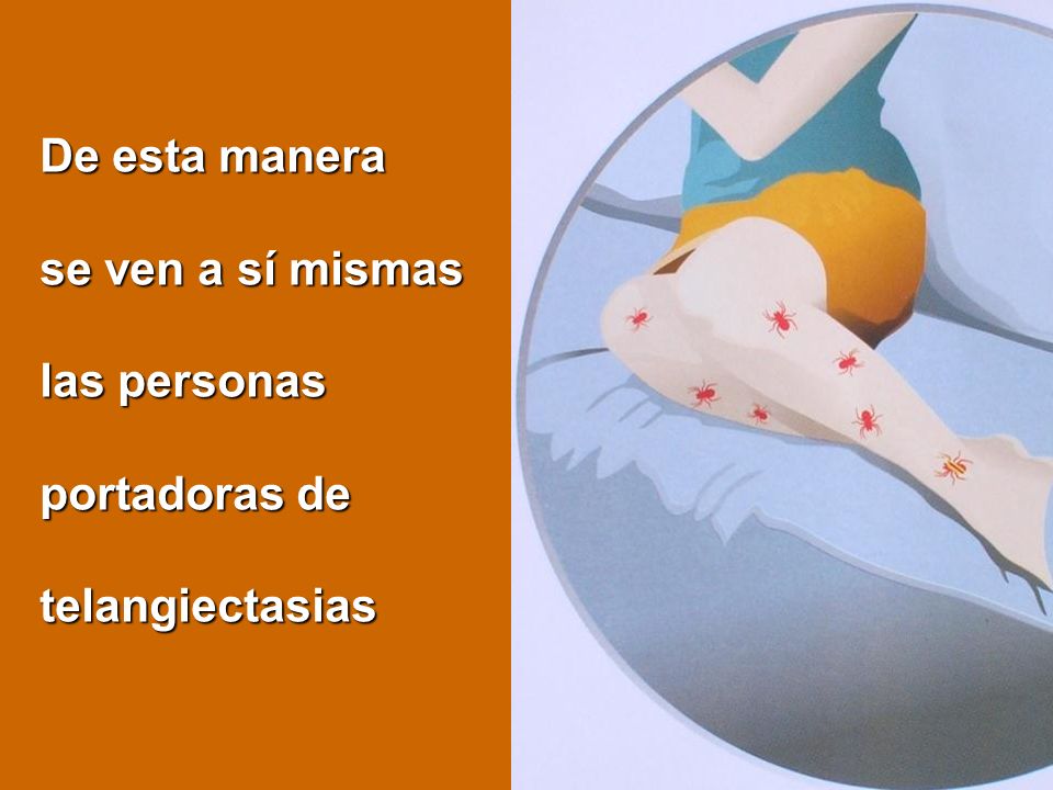 De esta manera se ven a sí mismas las personas portadoras de telangiectasias