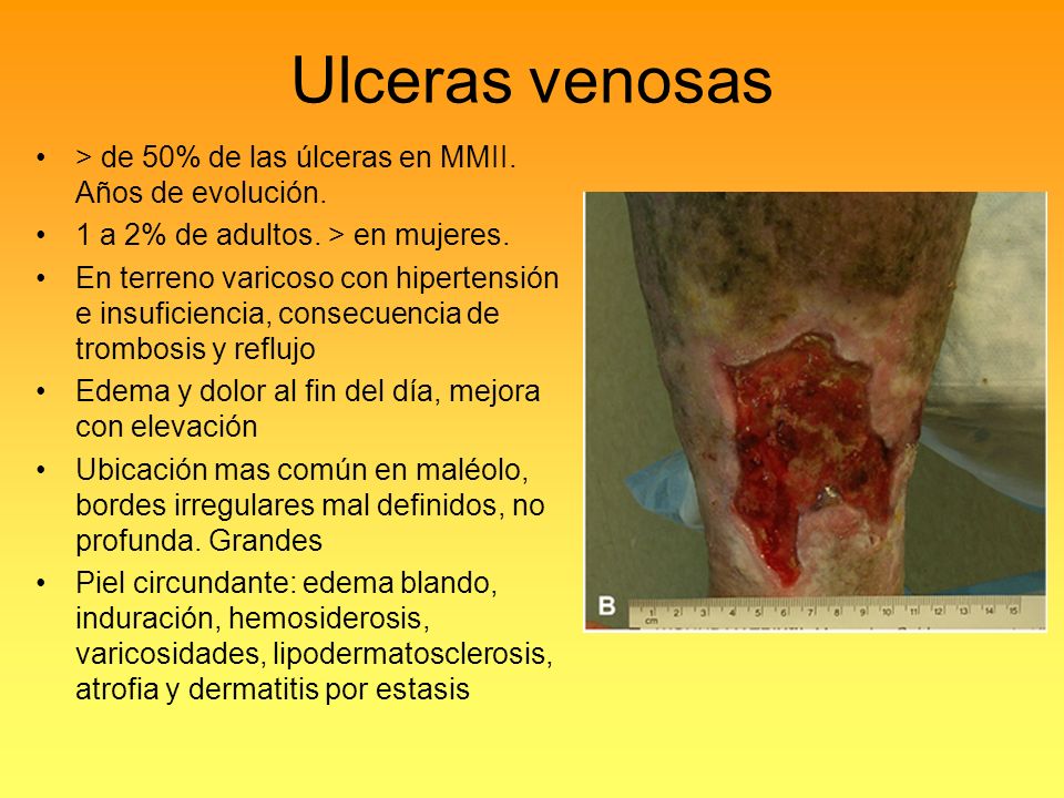 Ulceras venosas > de 50% de las úlceras en MMII. Años de evolución.