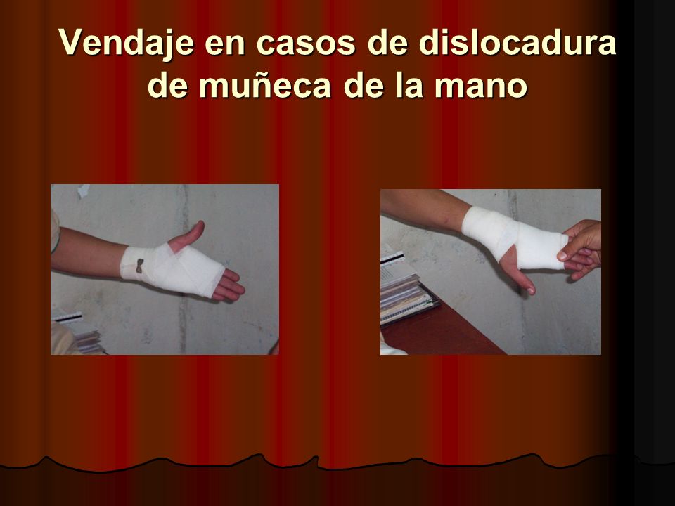 Vendaje en casos de dislocadura de muñeca de la mano
