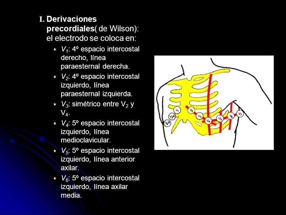 I. Derivaciones precordiales( de Wilson): el electrodo se coloca en:
