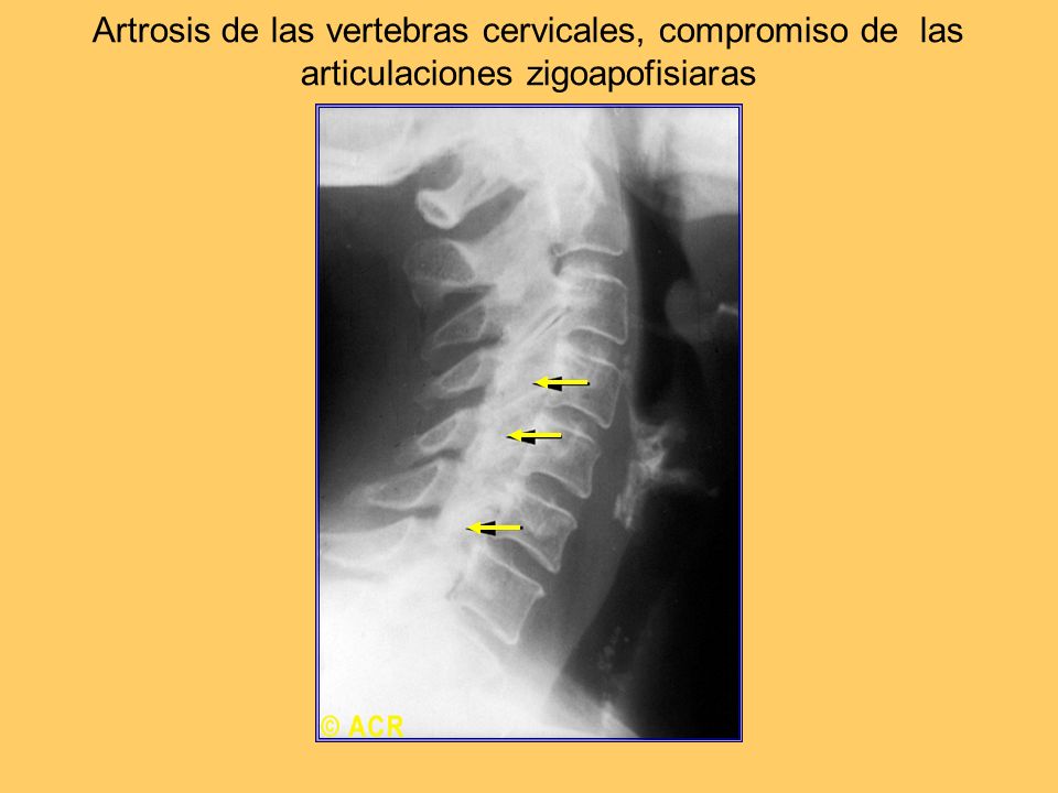 Artrosis de las vertebras cervicales, compromiso de las articulaciones zigoapofisiaras