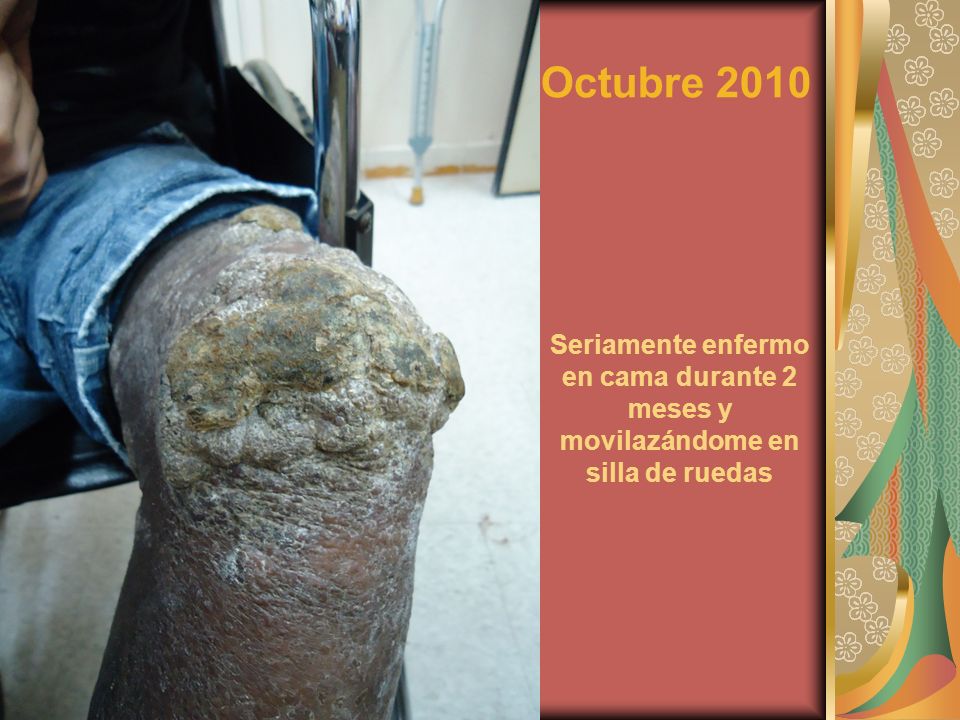 Octubre 2010 Seriamente enfermo en cama durante 2 meses y movilazándome en silla de ruedas