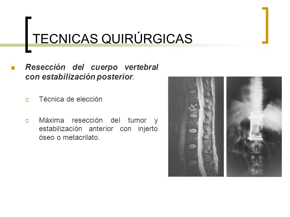 TECNICAS QUIRÚRGICAS Resección del cuerpo vertebral con estabilización posterior. Técnica de elección.