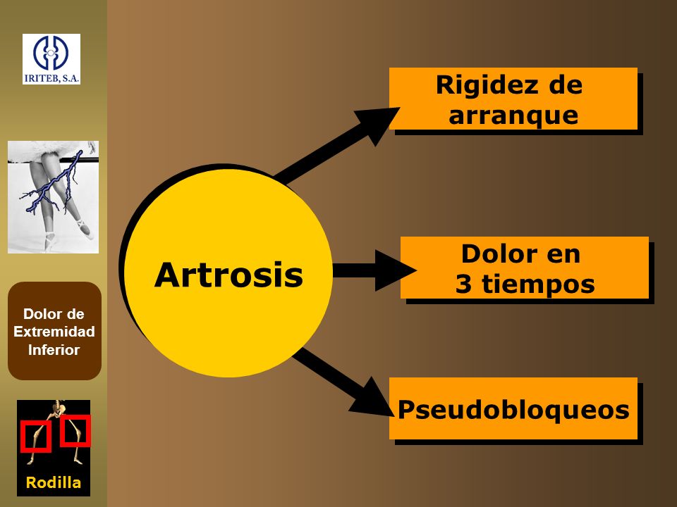 Rigidez de arranque Artrosis Dolor en 3 tiempos Pseudobloqueos Rodilla
