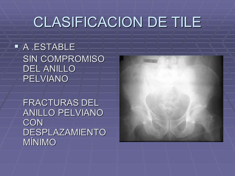 CLASIFICACION DE TILE A .ESTABLE SIN COMPROMISO DEL ANILLO PELVIANO