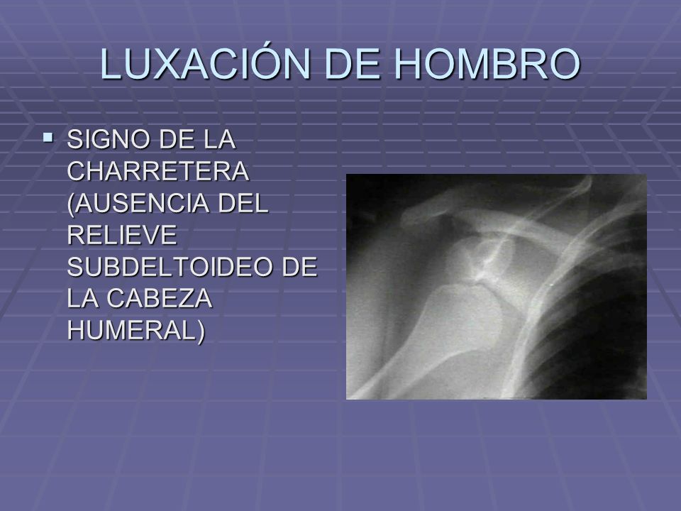 LUXACIÓN DE HOMBRO SIGNO DE LA CHARRETERA (AUSENCIA DEL RELIEVE SUBDELTOIDEO DE LA CABEZA HUMERAL)