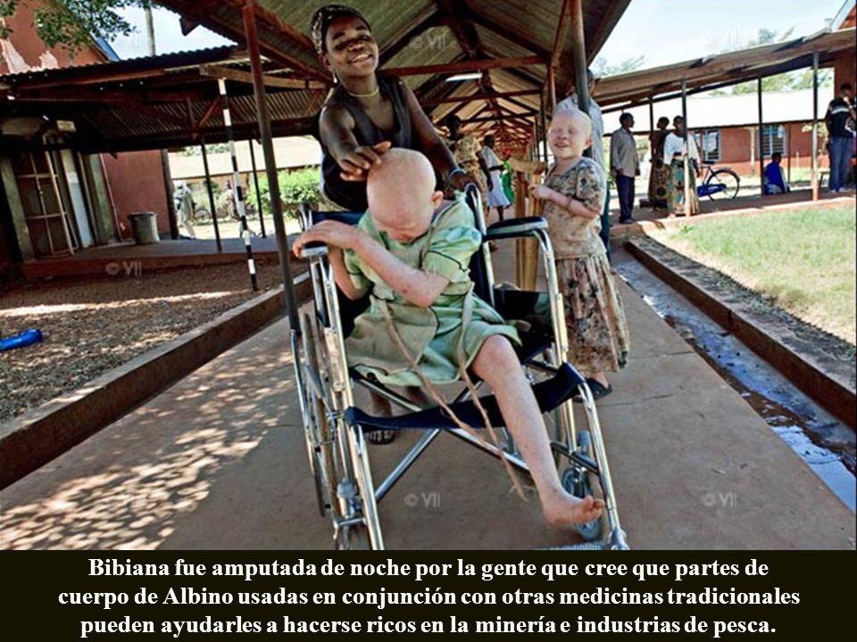 Bibiana fue amputada de noche por la gente que cree que partes de cuerpo de Albino usadas en conjunción con otras medicinas tradicionales pueden ayudarles a hacerse ricos en la minería e industrias de pesca.