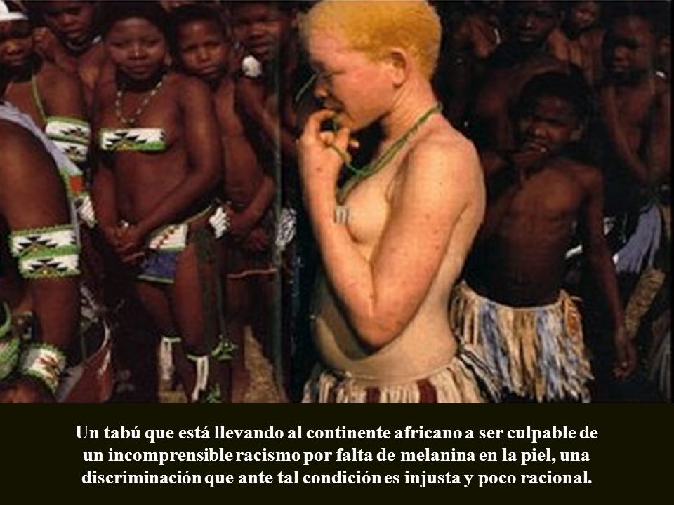Un tabú que está llevando al continente africano a ser culpable de un incomprensible racismo por falta de melanina en la piel, una discriminación que ante tal condición es injusta y poco racional.