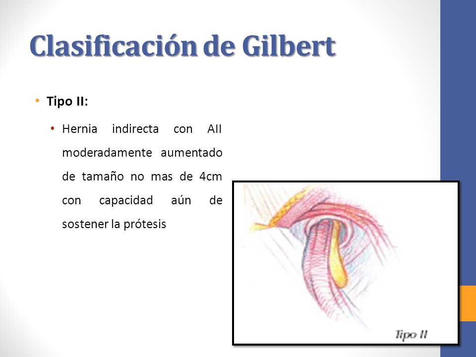 Clasificación de Gilbert