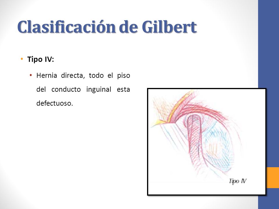 Clasificación de Gilbert