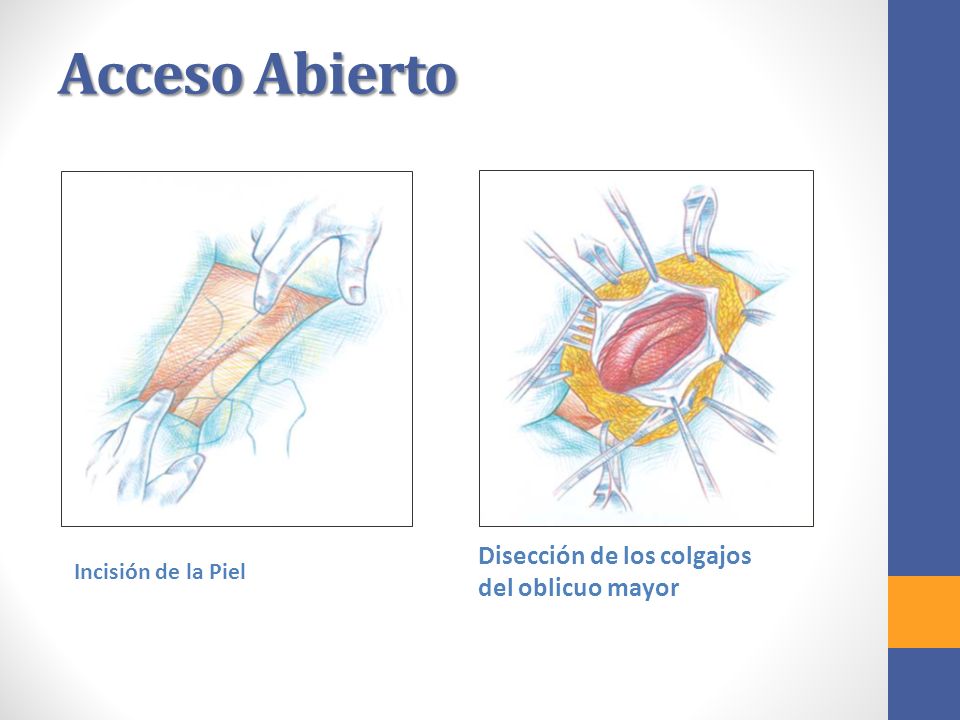 Acceso Abierto Disección de los colgajos del oblicuo mayor