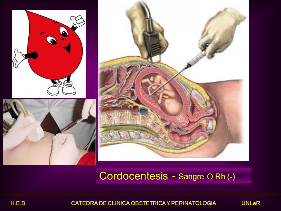 Cordocentesis - Sangre O Rh (-)