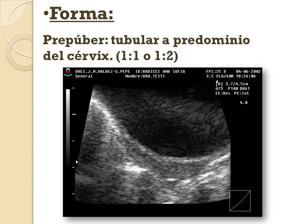 Forma: Prepúber: tubular a predominio del cérvix. (1:1 o 1:2)