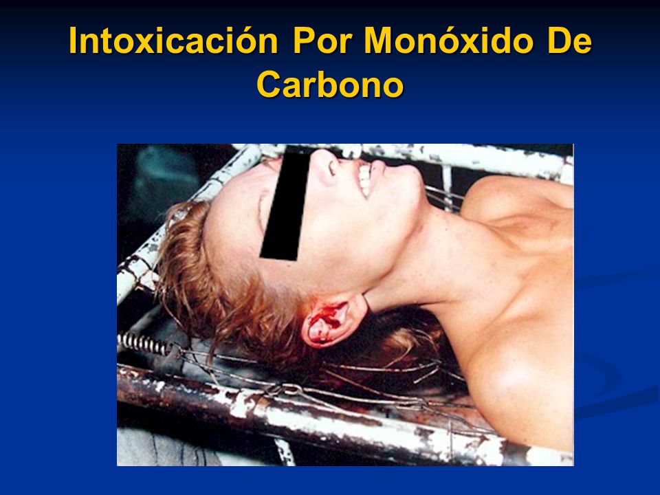 Intoxicación Por Monóxido De Carbono
