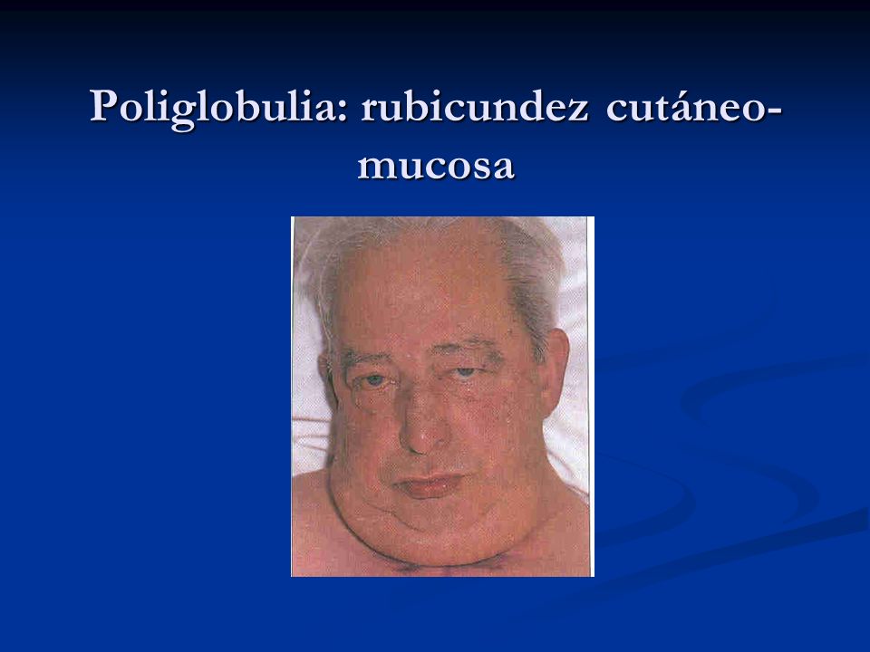 Poliglobulia: rubicundez cutáneo-mucosa