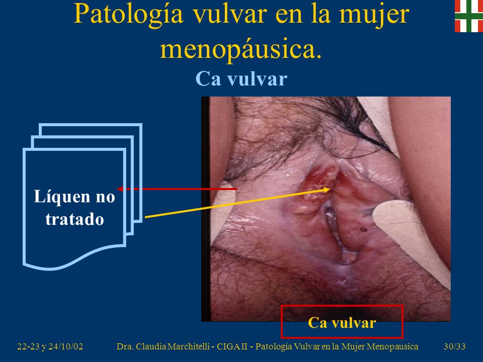 Patología vulvar en la mujer menopáusica. Ca vulvar