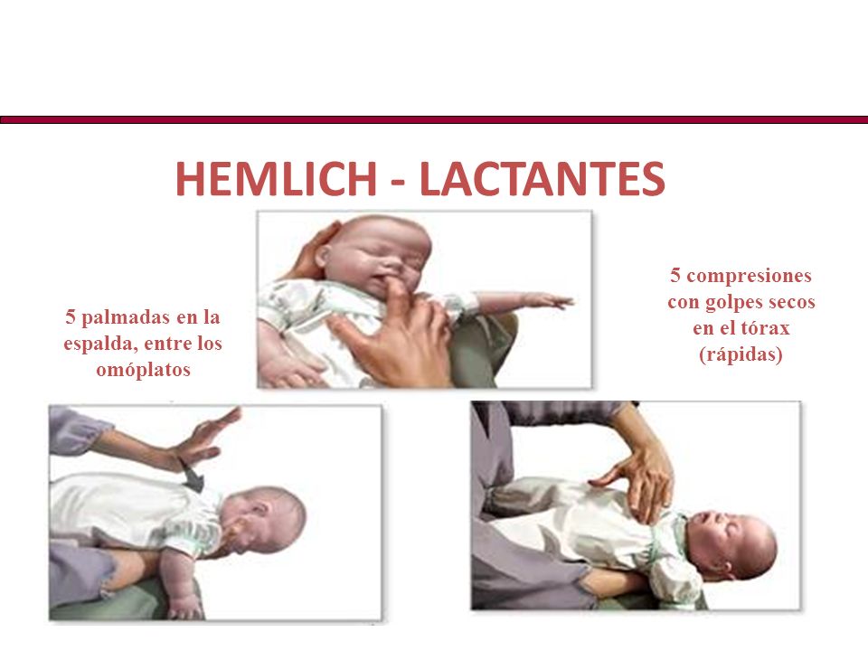 HEMLICH - LACTANTES 5 compresiones con golpes secos en el tórax (rápidas) 5 palmadas en la espalda, entre los omóplatos.
