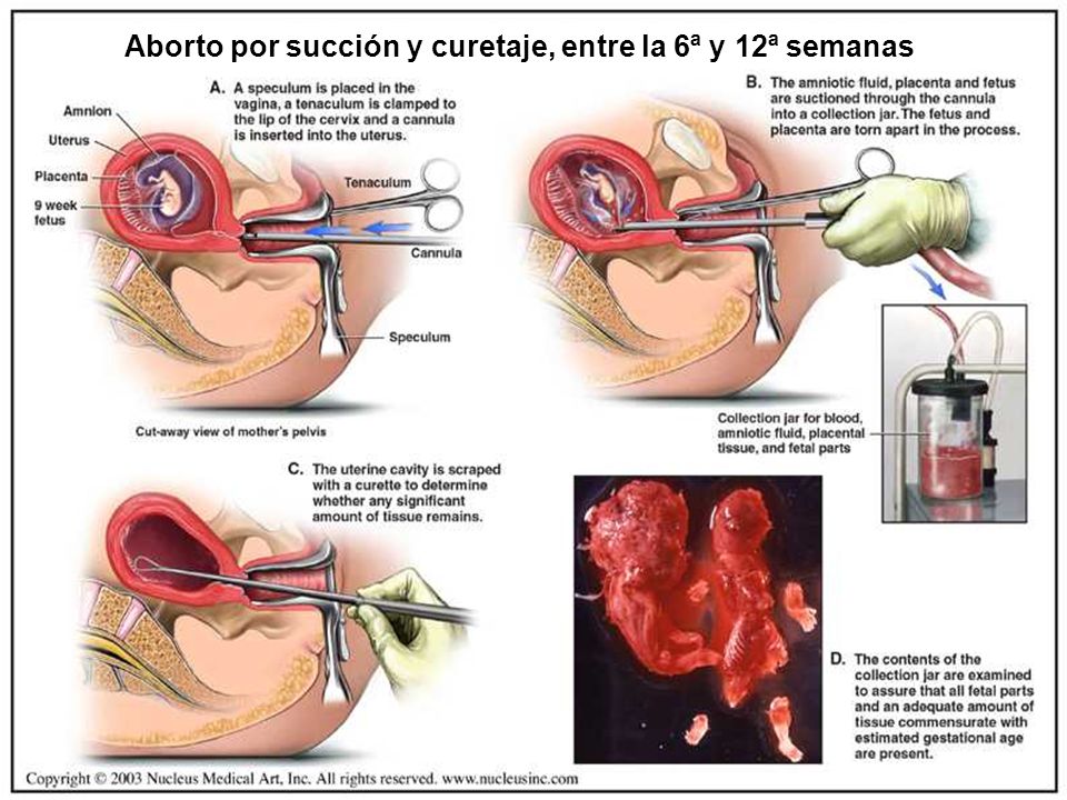 Aborto por succión y curetaje, entre la 6ª y 12ª semanas