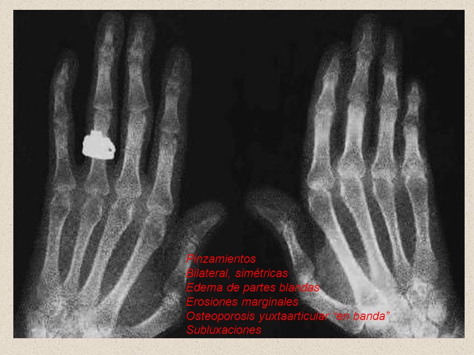 Pinzamientos Bilateral, simétricas. Edema de partes blandas. Erosiones marginales. Osteoporosis yuxtaarticular en banda