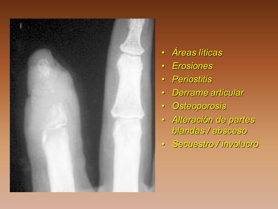 Áreas líticas Erosiones. Periostitis. Derrame articular. Osteoporosis. Alteración de partes blandas / absceso.