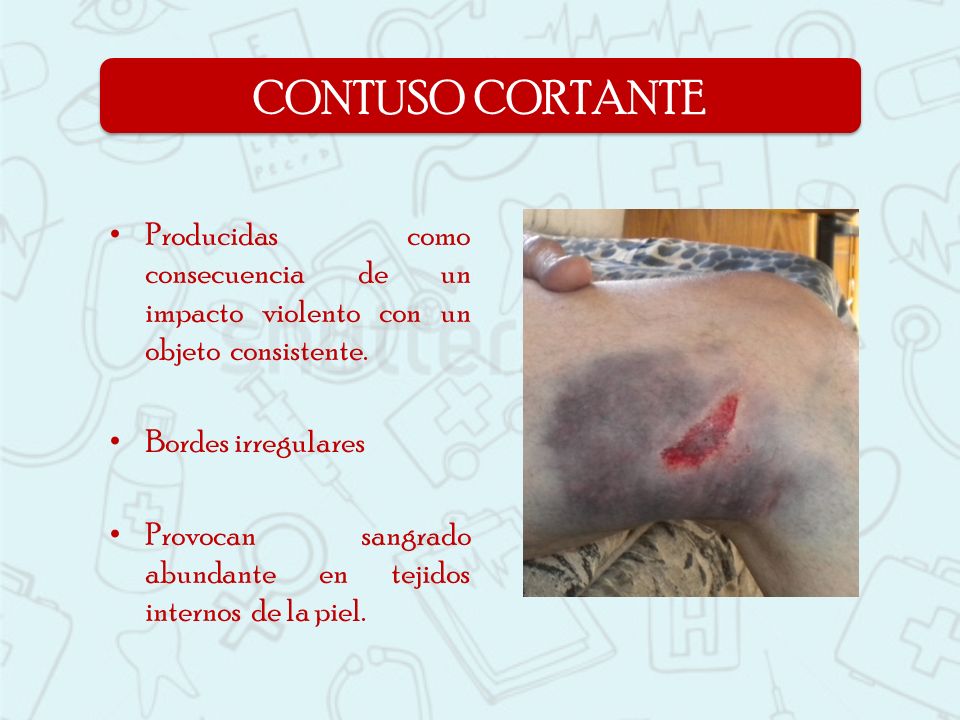 CONTUSO CORTANTE Producidas como consecuencia de un impacto violento con un objeto consistente. Bordes irregulares.