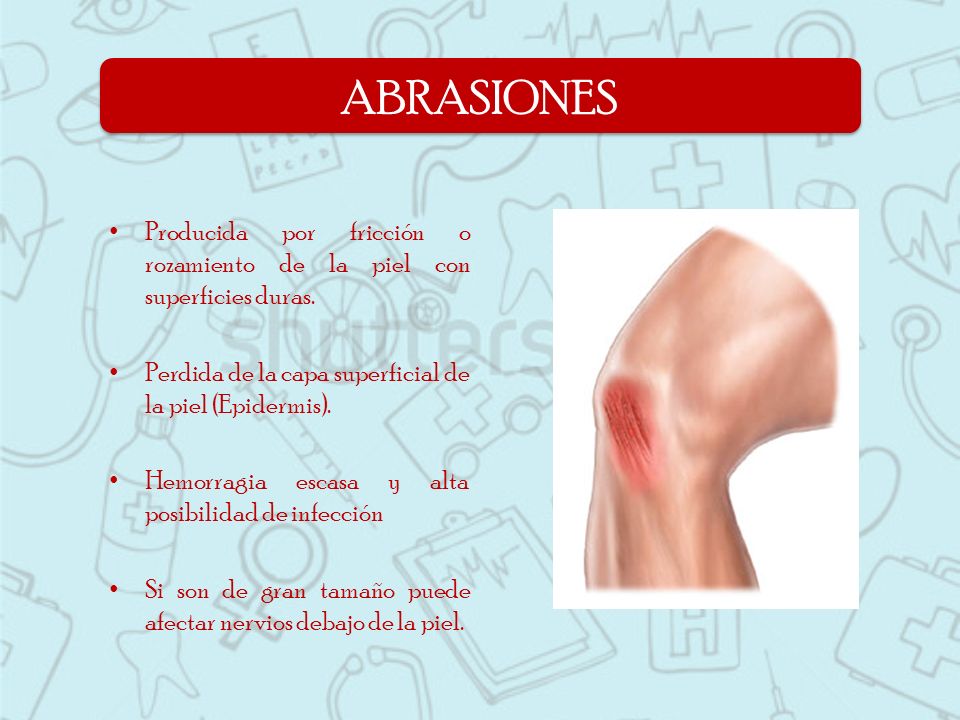 ABRASIONES Producida por fricción o rozamiento de la piel con superficies duras. Perdida de la capa superficial de la piel (Epidermis).