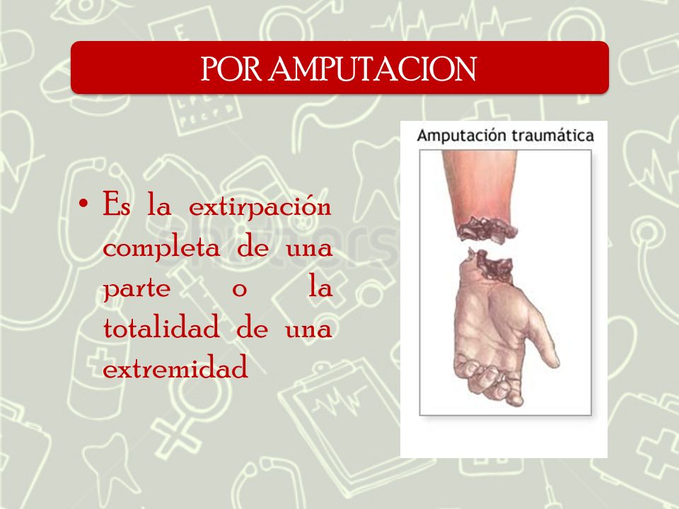 POR AMPUTACION Es la extirpación completa de una parte o la totalidad de una extremidad