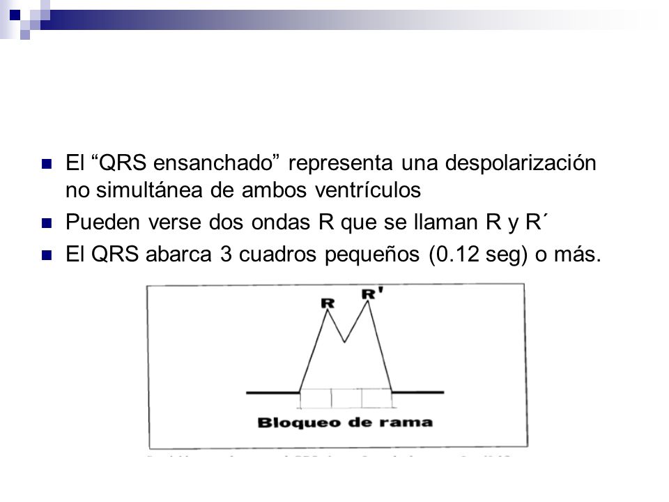 El QRS ensanchado representa una despolarización no simultánea de ambos ventrículos