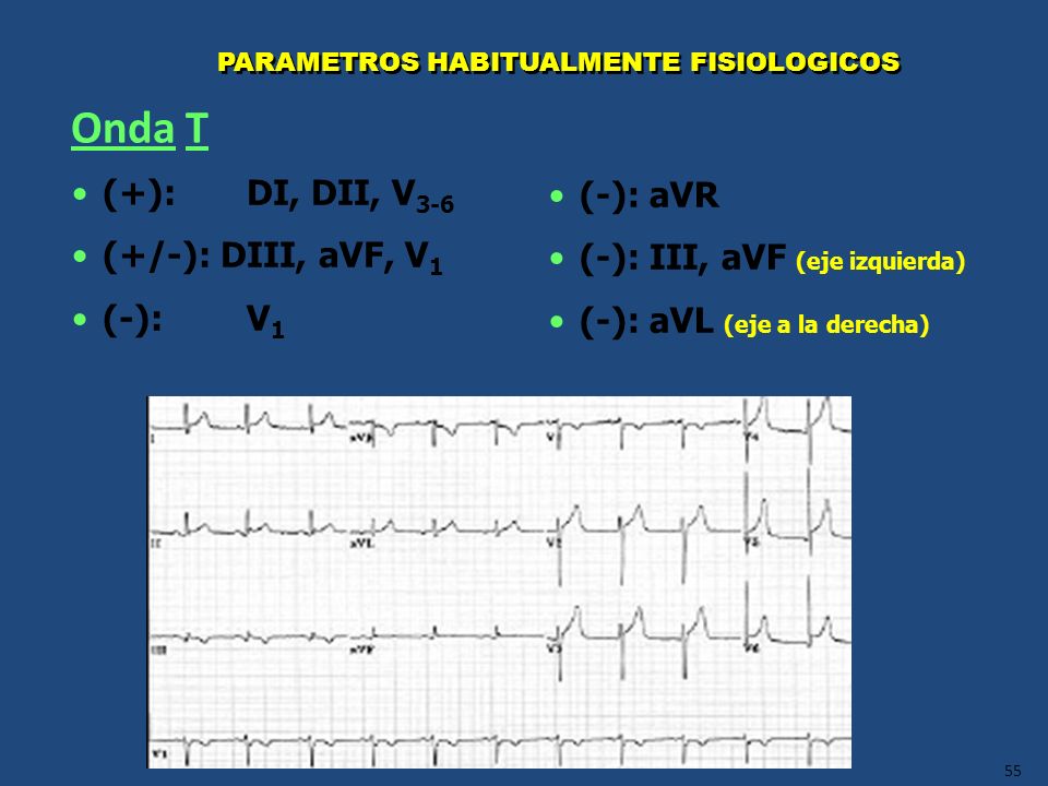 Onda T (+): DI, DII, V3-6 (-): aVR (+/-): DIII, aVF, V1
