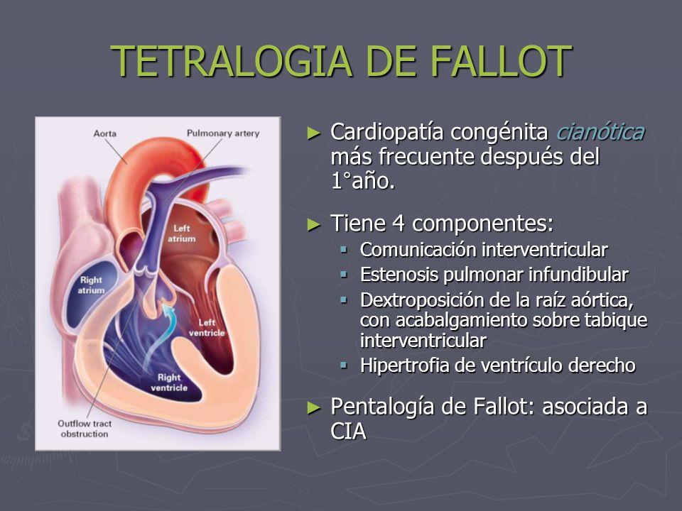 TETRALOGIA DE FALLOT Cardiopatía congénita cianótica más frecuente después del 1°año. Tiene 4 componentes: