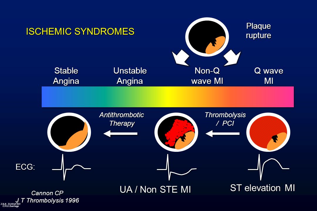 ISCHEMIC SYNDROMES ST elevation MI UA / Non STE MI Stable Angina