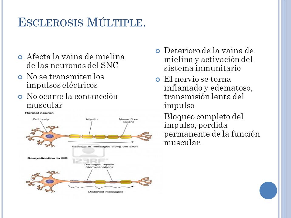 Esclerosis Múltiple. Deterioro de la vaina de mielina y activación del sistema inmunitario.