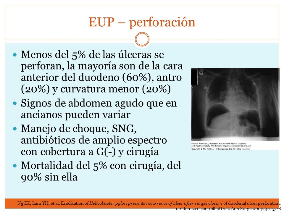 EUP – perforación Menos del 5% de las úlceras se perforan, la mayoría son de la cara anterior del duodeno (60%), antro (20%) y curvatura menor (20%)