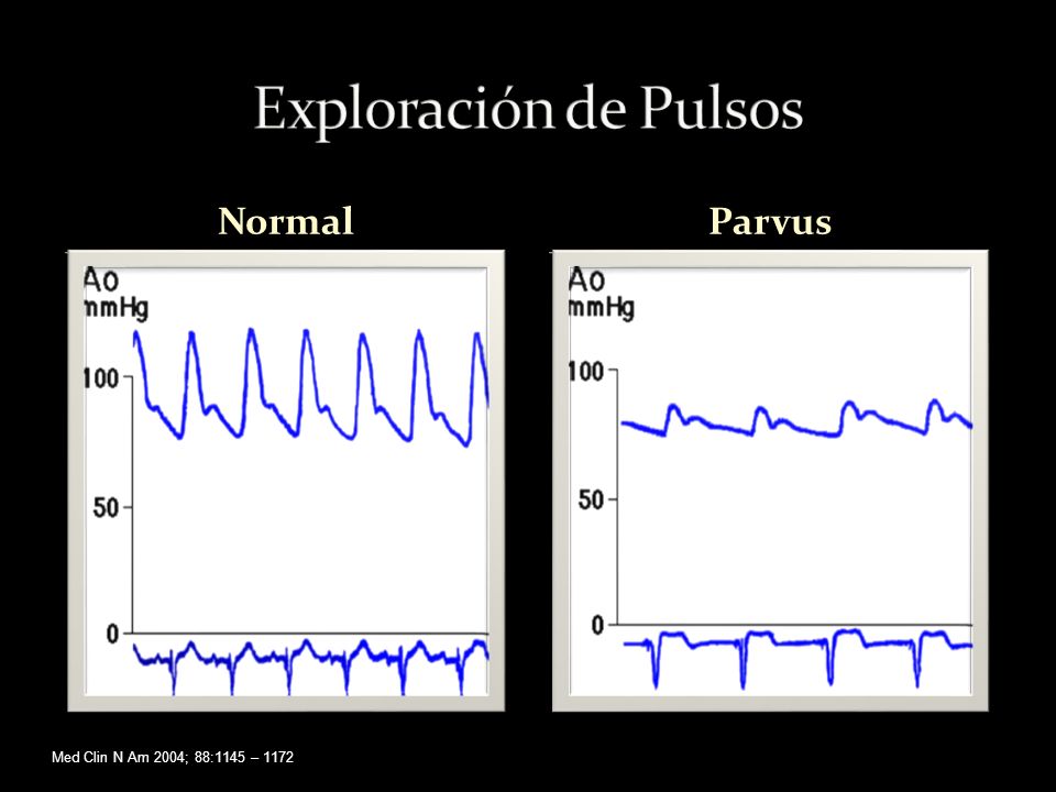 Exploración de Pulsos Normal Parvus Med Clin N Am 2004; 88:1145 – 1172