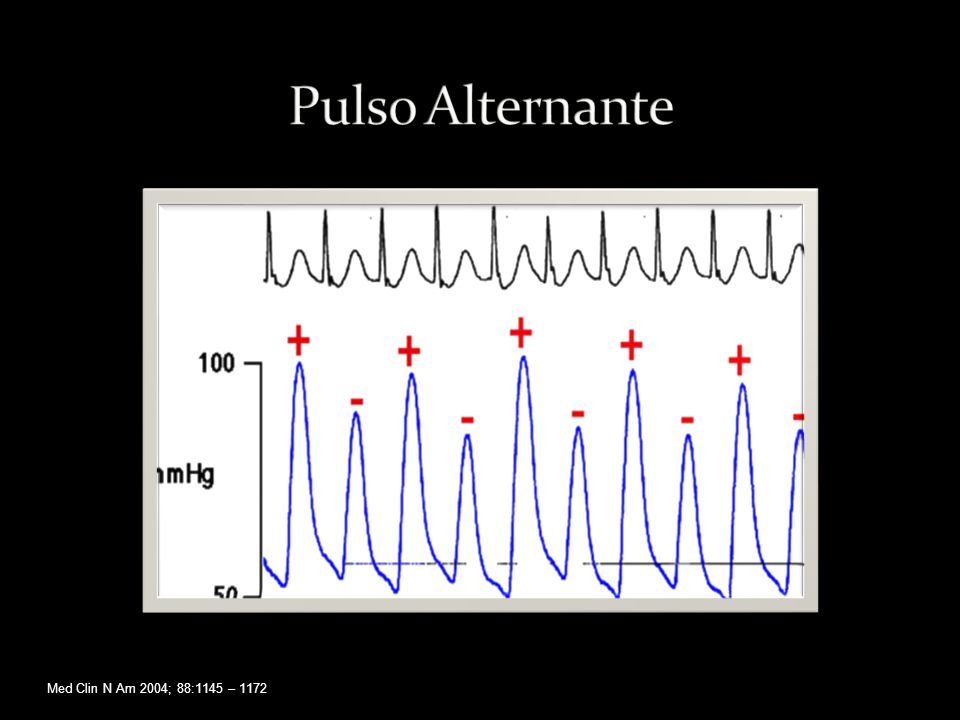 Pulso Alternante Med Clin N Am 2004; 88:1145 – 1172