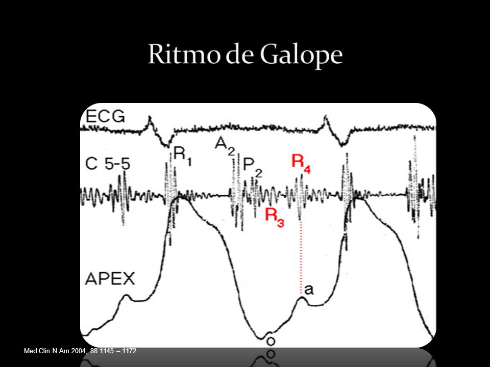 Ritmo de Galope Med Clin N Am 2004; 88:1145 – 1172