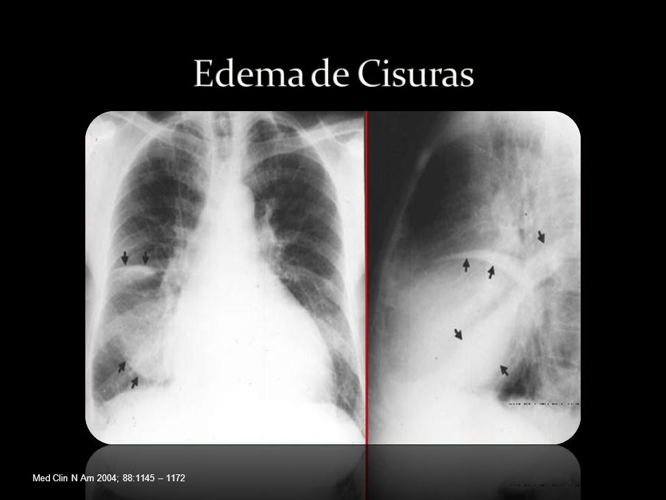 Edema de Cisuras Med Clin N Am 2004; 88:1145 – 1172