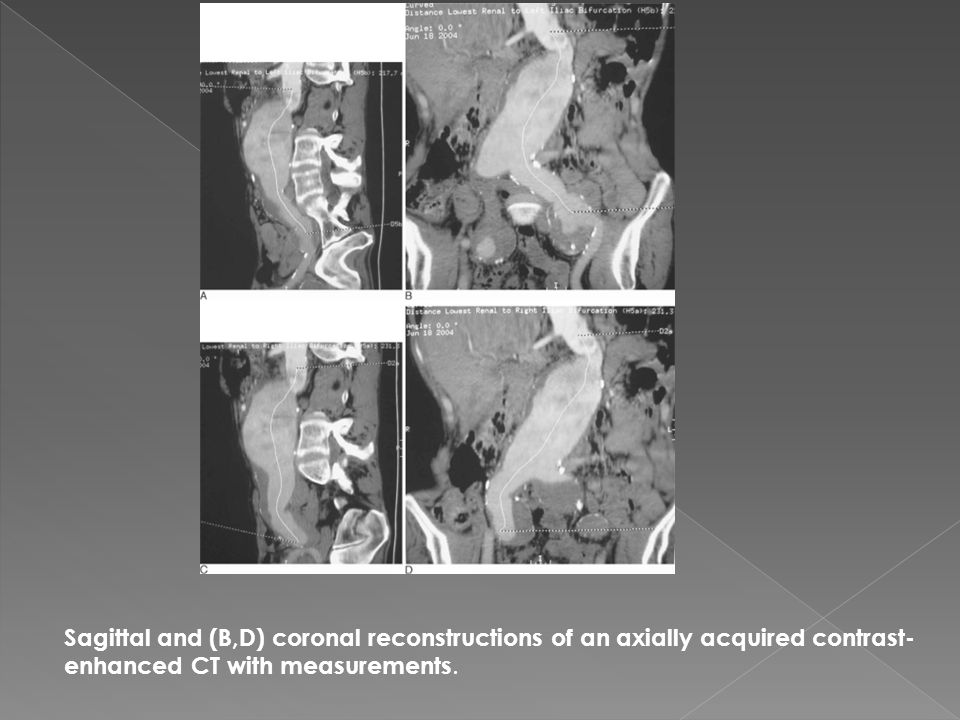 Sagittal and (B,D) coronal reconstructions of an axially acquired contrast-enhanced CT with measurements.