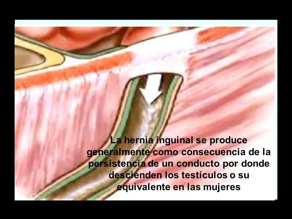 La hernia inguinal se produce generalmente como consecuencia de la persistencia de un conducto por donde descienden los testículos o su equivalente en las mujeres