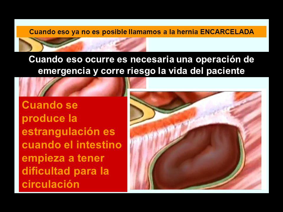 Cuando eso ya no es posible llamamos a la hernia ENCARCELADA
