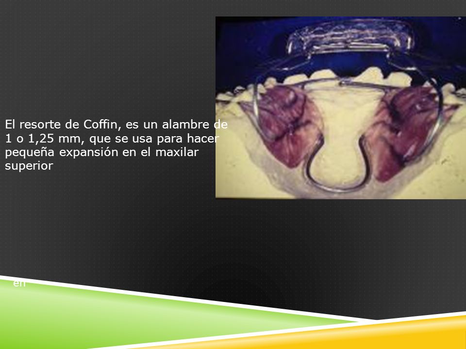 El resorte de Coffin, es un alambre de 1 o 1,25 mm, que se usa para hacer pequeña expansión en el maxilar superior