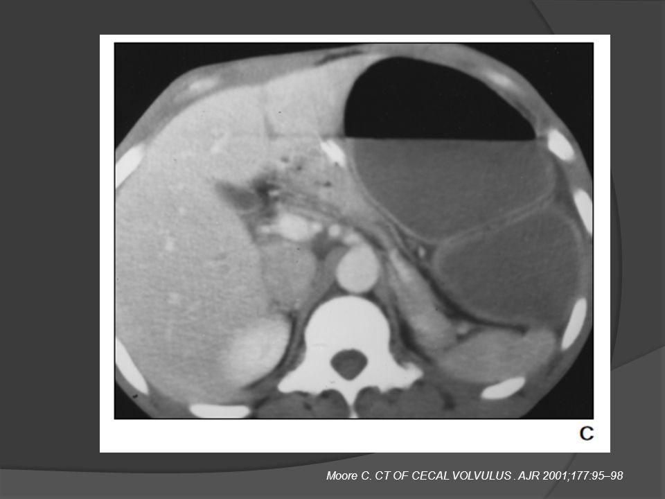 Moore C. CT OF CECAL VOLVULUS . AJR 2001;177:95–98