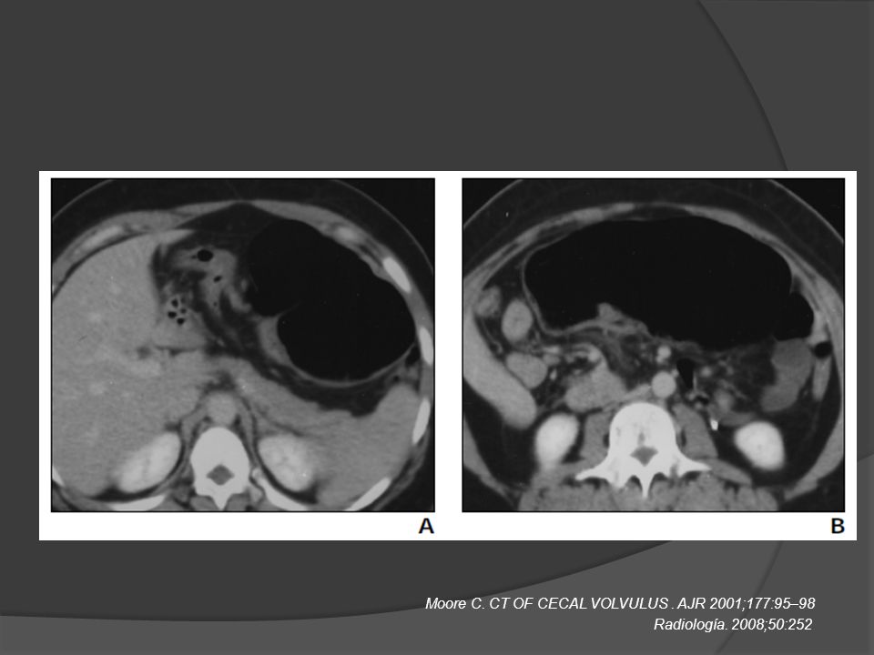 Moore C. CT OF CECAL VOLVULUS . AJR 2001;177:95–98