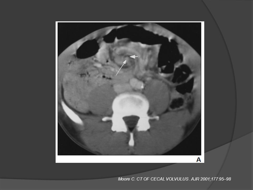 Moore C. CT OF CECAL VOLVULUS . AJR 2001;177:95–98
