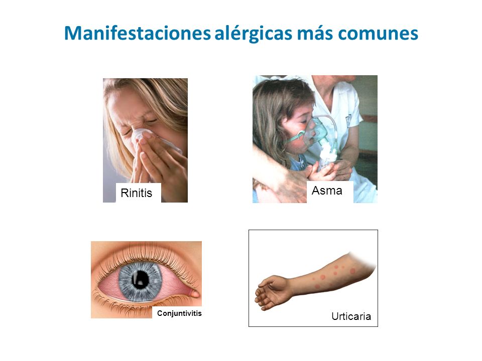 Manifestaciones alérgicas más comunes